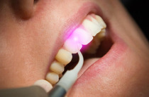 Schmerzfreie Laser Zahnbehandlung