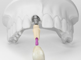 Zahnimplantate für Einzenzahnlücken