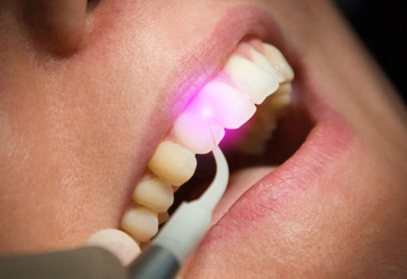 Laser Zahnbehandlung Nürnberg